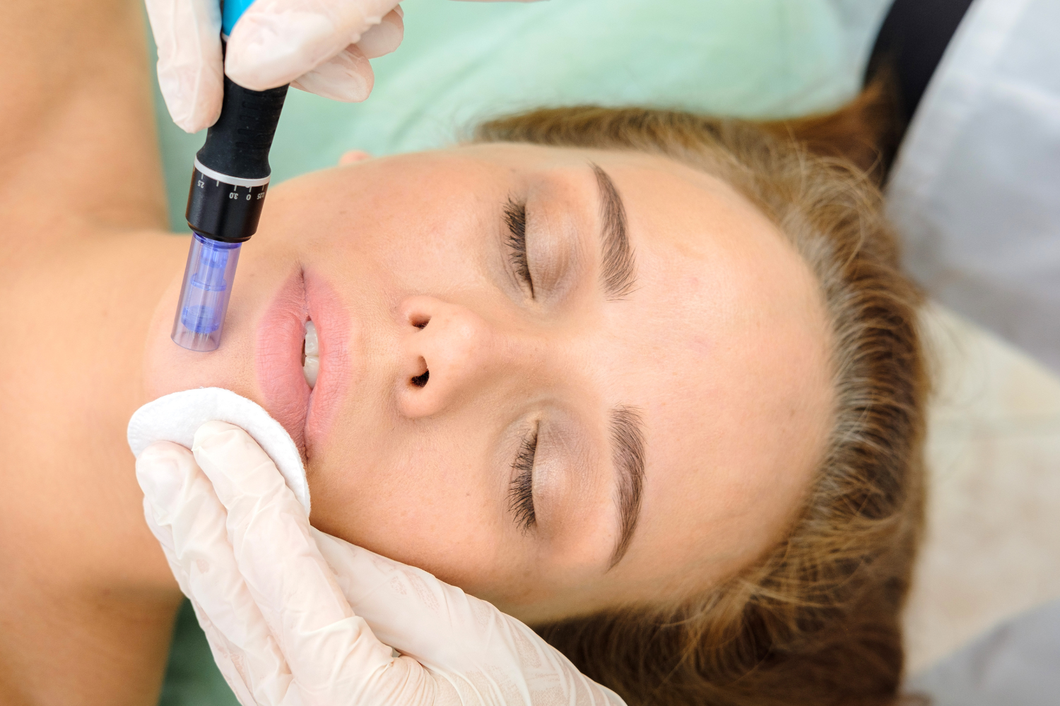 dermatologija/Microneedling-Ljubljana.png