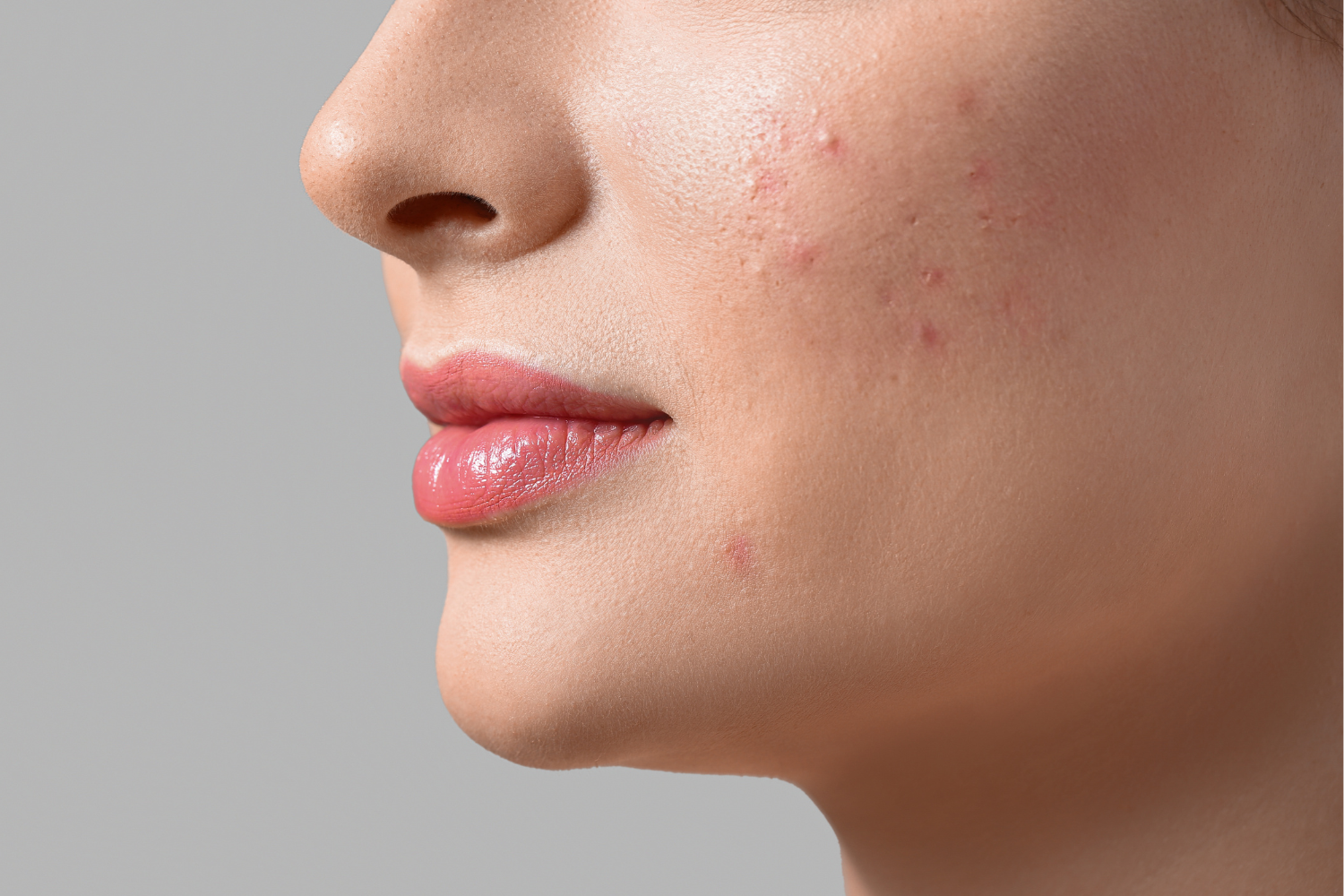 dermatologija/akne-dermatolog.png